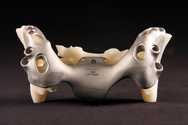 Напечатанный на 3D-принтере экспериментальный металлический имплантат