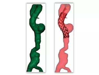 Индивидуальные анатомические модели для лечения аневризмы