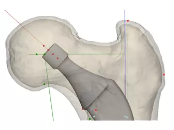 Восстановление биомеханики бедра с помощью цементного эндопротеза