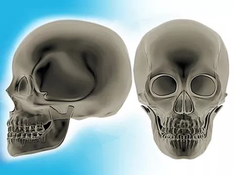 3D-печать для восстановления дефекта скуловой кости