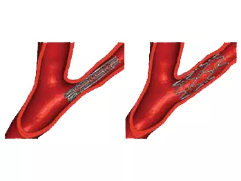 Проектирование имплантируемого стента