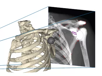 Цифровая рентгенография плечевого сустава