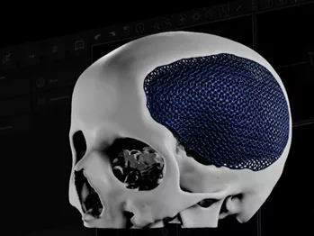 Проектирование индивидуального черепного имплантата