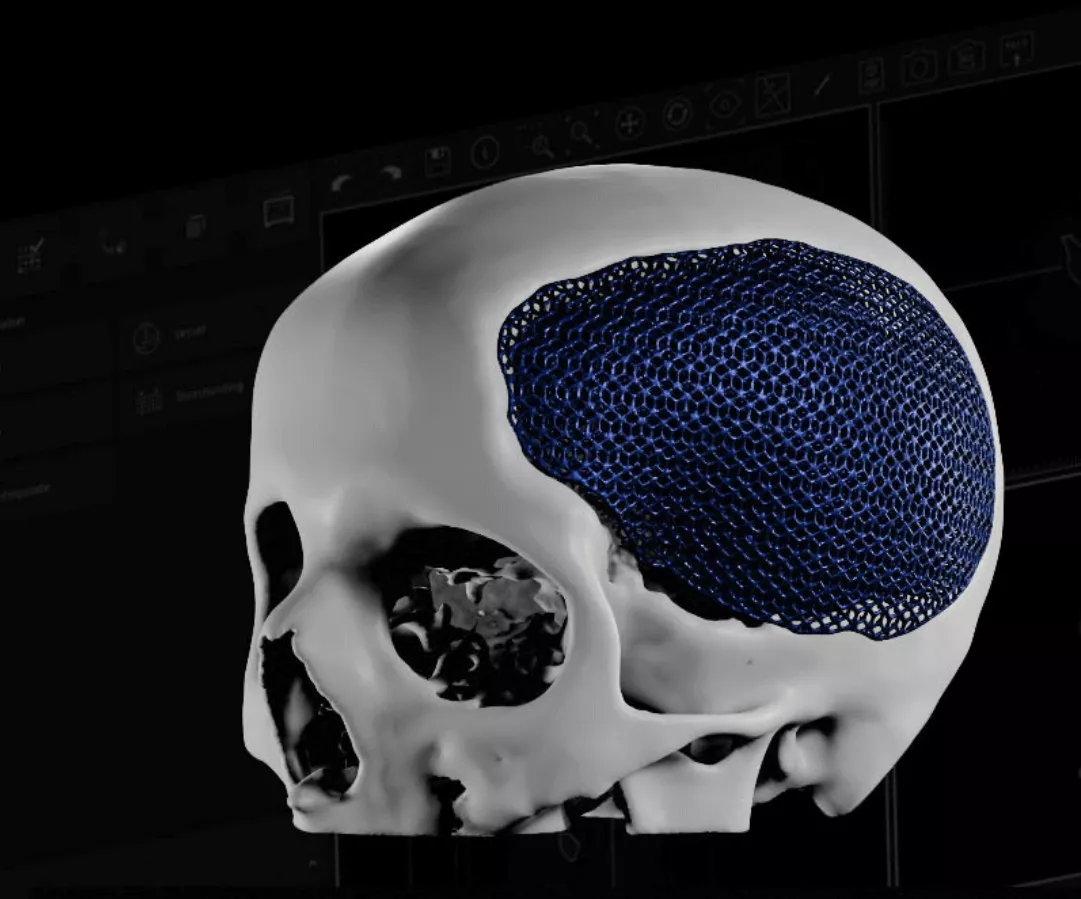 Индивидуальный черепной имплантат: проектирование и реализация