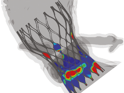 Оптимизация предоперационного планирования для транскатетерной замены аортального клапана