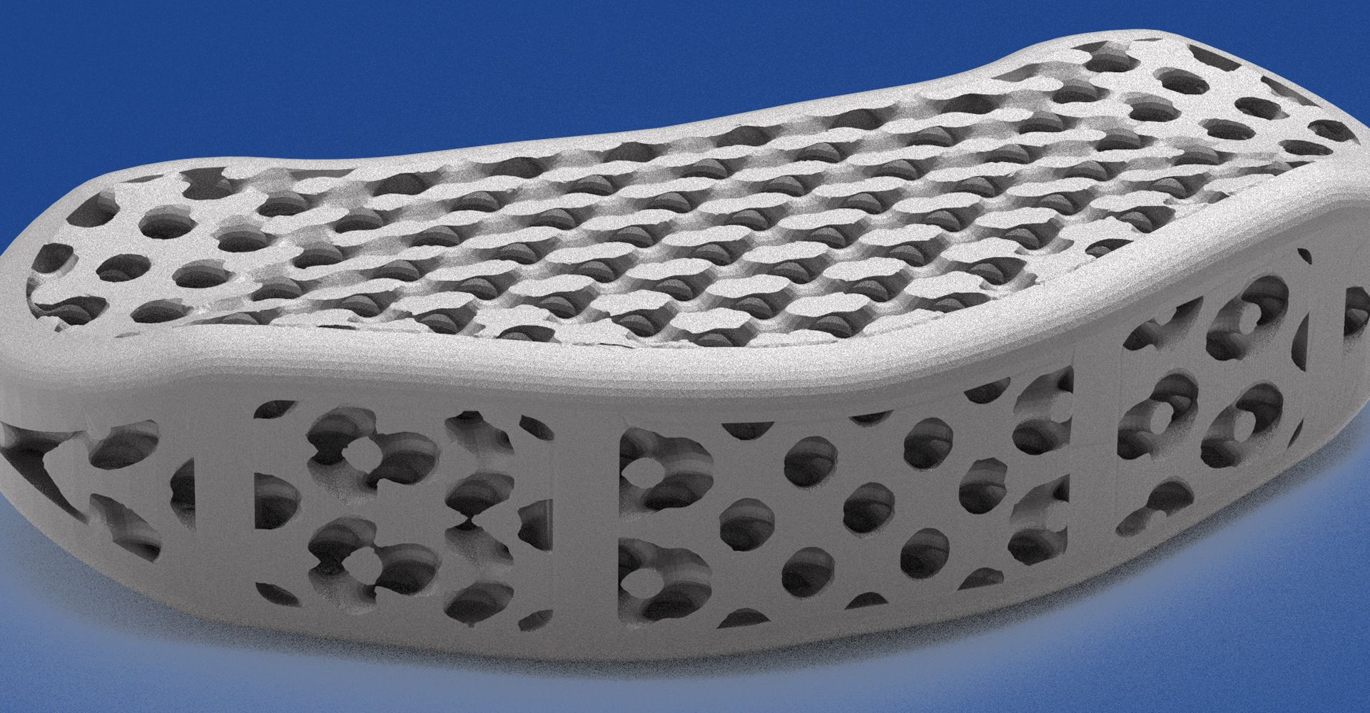 Новые успехи в создании кастомизированных ортопедических имплантатов