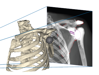Цифровая рентгенография плечевого сустава