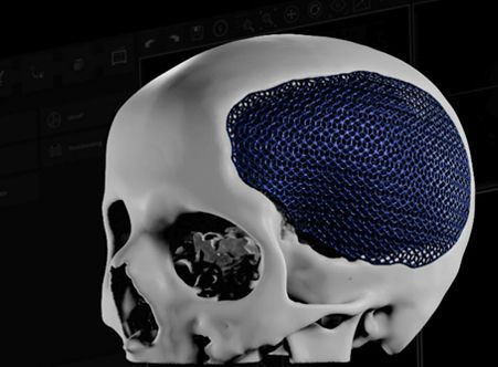 Оптимизация имплантатов по весу и по геометрии изделия с использованием ячеистых структур для 3D‑печати