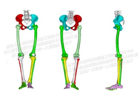 Эндопротезирование коленного сустава с применением 3D‑печати металлом