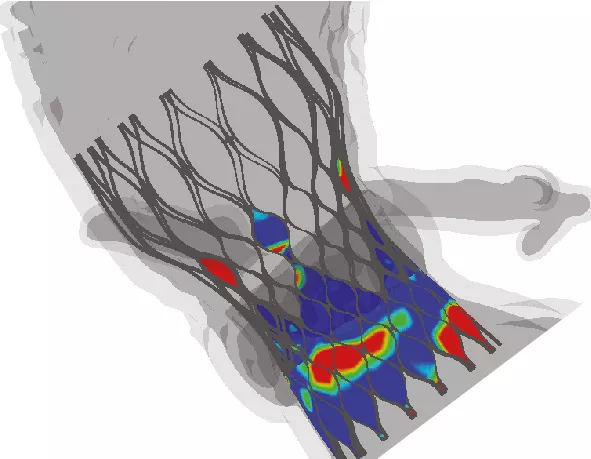 Оптимизация предоперационного планирования для транскатетерной замены аортального клапана